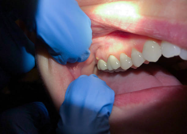Best Knocked-Out Tooth Emergency  in Plentywood, MT